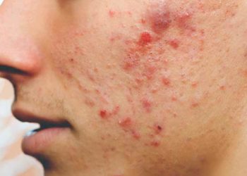 ବ୍ରଣ ରୁ ରକ୍ଷା ପାଇବା ପାଈଁ ଚାହୁଁଛନ୍ତି କି …