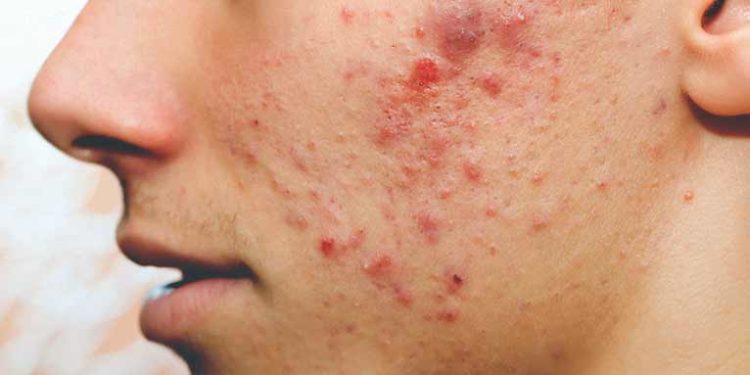 ବ୍ରଣ ରୁ ରକ୍ଷା ପାଇବା ପାଈଁ ଚାହୁଁଛନ୍ତି କି …