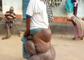 ଗରୀବ ଆଦବାସୀ ଦେବରାଜ ମୁଣ୍ଡା,ଘର ଚନ୍ଦ୍ରଶେଖର ପୁର, ନୂଆ ଗାଁ, ଚମ୍ପୁଆ ,ଜିଲ୍ଲା କେନ୍ଦୁଝର । ଅଜଣା ରୋଗରେ ଡାହାଣ ଗୋଡ଼ଟି ଅସ୍ବାଭାବିକ ଭାବରେ ଫୁଲିବାରେ ଲାଗିଛି । ଆର୍ଥିକ ଅବସ୍ଥା ଖରାପ ଥିବାରୁ ସେ ସରକାରଙ୍କ ଅବଦାନ କୁ ଅପେକ୍ଷା କରିଛନ୍ତି ।