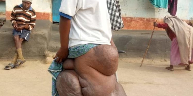 ଗରୀବ ଆଦବାସୀ ଦେବରାଜ ମୁଣ୍ଡା,ଘର ଚନ୍ଦ୍ରଶେଖର ପୁର, ନୂଆ ଗାଁ, ଚମ୍ପୁଆ ,ଜିଲ୍ଲା କେନ୍ଦୁଝର । ଅଜଣା ରୋଗରେ ଡାହାଣ ଗୋଡ଼ଟି ଅସ୍ବାଭାବିକ ଭାବରେ ଫୁଲିବାରେ ଲାଗିଛି । ଆର୍ଥିକ ଅବସ୍ଥା ଖରାପ ଥିବାରୁ ସେ ସରକାରଙ୍କ ଅବଦାନ କୁ ଅପେକ୍ଷା କରିଛନ୍ତି ।